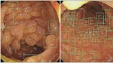 AI大腸鏡一照「息肉超驚人」 醫：所有員工直接尖叫