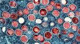 3 children in Georgia test positive for monkeypox: Officials
