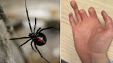 Man has fingers amputated after shocking spider bite on holiday in Ibiza