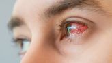 What you need to know about eye syphilis