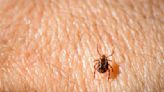 Rocky Mountain Spotted Fever: What You Need to Know