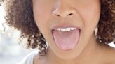 What Causes Geographic Tongue, the Mysterious Taste Bud Condition?