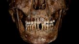 17th-century Frenchwoman's 'innovative' gold dental work was likely torturous to her teeth