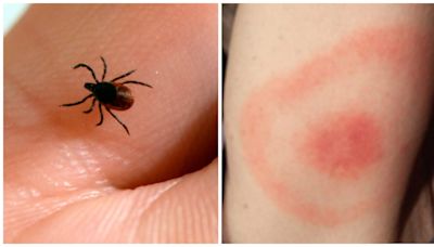 Ticks are back. Here's what experts say you should watch out for