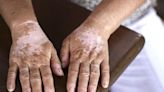 What Causes Vitiligo?
