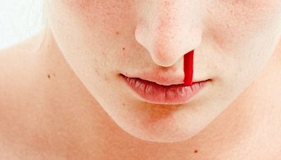 流鼻血原因可大可小 持續定期滴幾滴最得人驚（附止鼻血方法） | am730