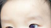 Baby boy’s eyes dramatically change colour after Covid treatment
