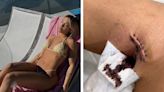 People are criticizing an influencer for tanning weeks after getting a skin cancer lesion removed