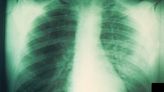 Human radiologists beat AI in diagnosing common lung diseases on X-rays