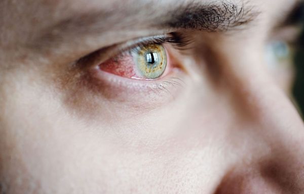 What Is Eye Syphilis? The Severe Symptom Doctors Are Seeing amid the STD Epidemic