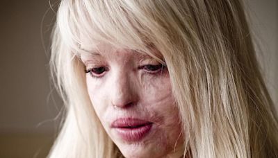 Decision to free Katie Piper acid attack stalker to be made next month