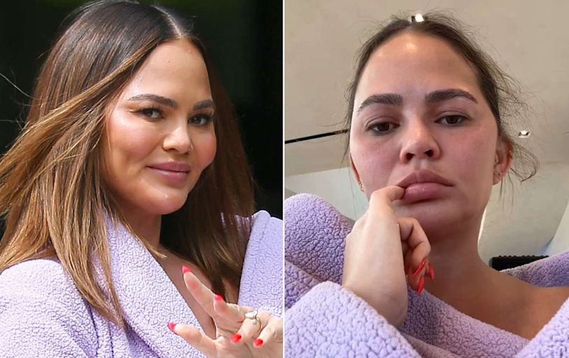 Chrissy Teigen Shares Honest Health Video: ’The Face of a Double Ear Infection’