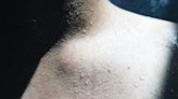 Basal cell carcinoma: Types, diagnosis, and more