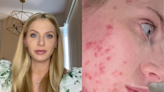 Emily Karlsson talks years-long acne struggle: 'I couldn't enjoy my pregnancy'