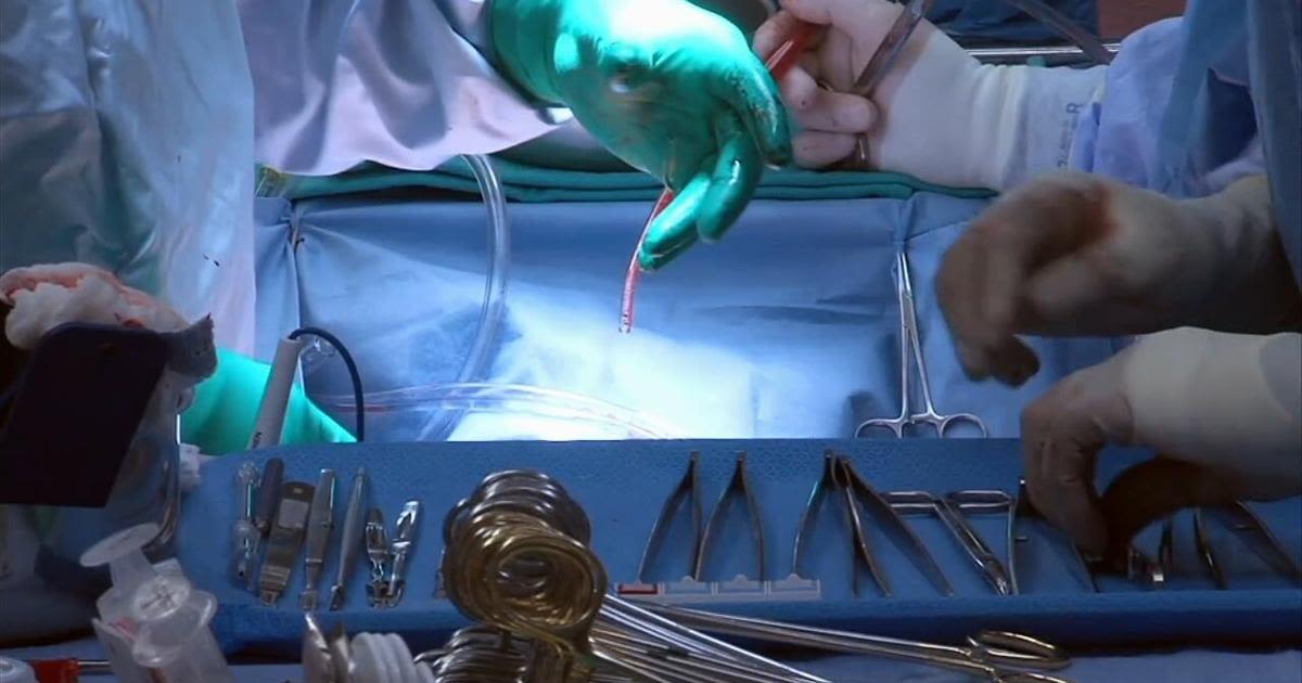 Health Beat: Revolutionizing kidney transplants