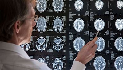 Covid-19 pode impactar cérebro como a esquizofrenia, diz pesquisa