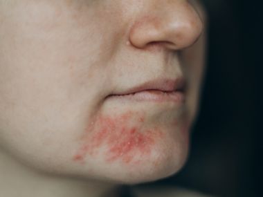 夏天臉紅通通可能是1疾病！醫師分享護膚妙招告別泛紅