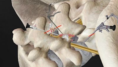 背、下肢痛數年原來是「椎弓根解離性滑脫」 這手術解大患 - 自由健康網