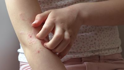 濕疹｜異位性皮膚炎是富貴病？女兒長年未癒 父母生活使費大出血
