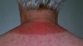 Hell’s Itch: How to Find Relief From Severe Sunburn Itch