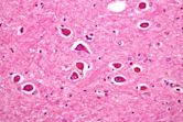 Hepatic encephalopathy