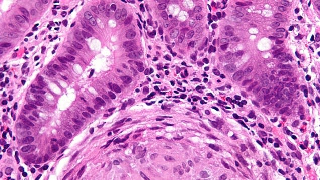 Scientists Uncover Potential Major Cause of Inflammatory Bowel Disease