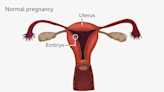 New drug could help women avoid ectopic pregnancy surgery