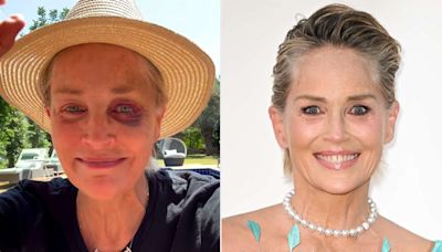 Sharon Stone reveals how she got a black eye after fan reaction to alarming injury photo