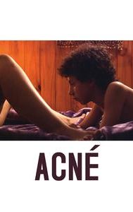 Acne (film)