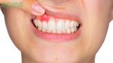 牙齦腫脹6大成因曝！牙醫揭「超常見族群」易遭殃：1習慣恐釀惡性循環