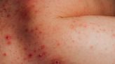 Eczema Before, During, and After Menopause