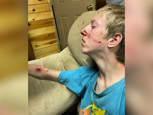 GRAPHIC: 15-year-old boy attacked by bear that got in family’s cabin