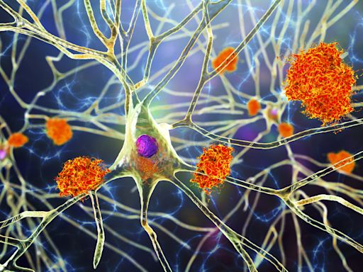 Alzheimer's breakthrough could halt progression