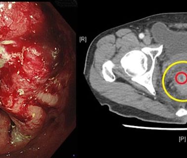 他血便1年誤以為痔瘡 醫肛門指診竟直腸癌3期：示警「4症狀」快檢查
