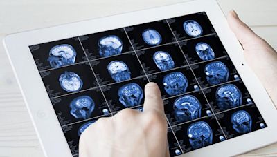 Esclerosis Múltiple: Cerca de 3000 personas necesitan tratamientos adecuados