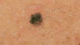 Melanoma May brings awareness to the deadliest form of skin cancer