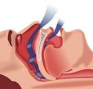 sleep apnea