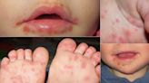 Autoridades de Holguín advierten sobre enfermedad contagiosa en niños