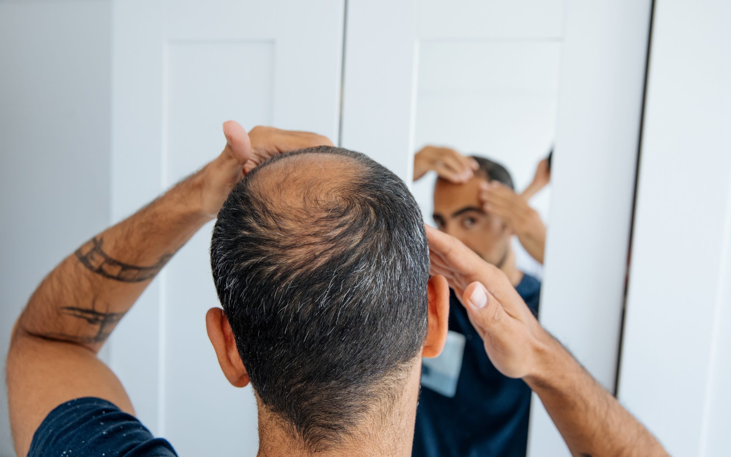 Men on hair-loss drug warned of sexual and psychiatric side effects