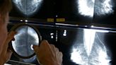 Mammograms should start at 40 to address rising breast cancer rates at younger ages, panel says