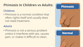 Phimosis in Children and Adults