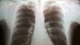 全球湧入大量「兒童白肺」！專家曝「4大擔憂」：無症狀、無明顯咳嗽 做2事防感染