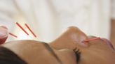 Everything You Need To Know About Facial Acupuncture | Essence