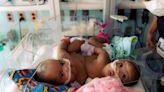 Texas Hospital Separates Conjoined Twins In “Historic” 11-Hour Surgery