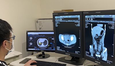 桃市擴大肺癌篩檢揪118人確診 長期暴露油煙廚師檢出肺癌1期 - 自由健康網