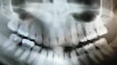 Getting a dental X-ray? A new recommendation says you don't need a lead apron