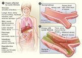 Cystic fibrosis