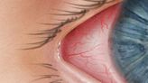 Got pink eye? Or is it COVID with pink eye? What to know about novel coronavirus among us