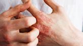 Researchers tie Lebrikizumab to sustained atopic dermatitis treatment effect