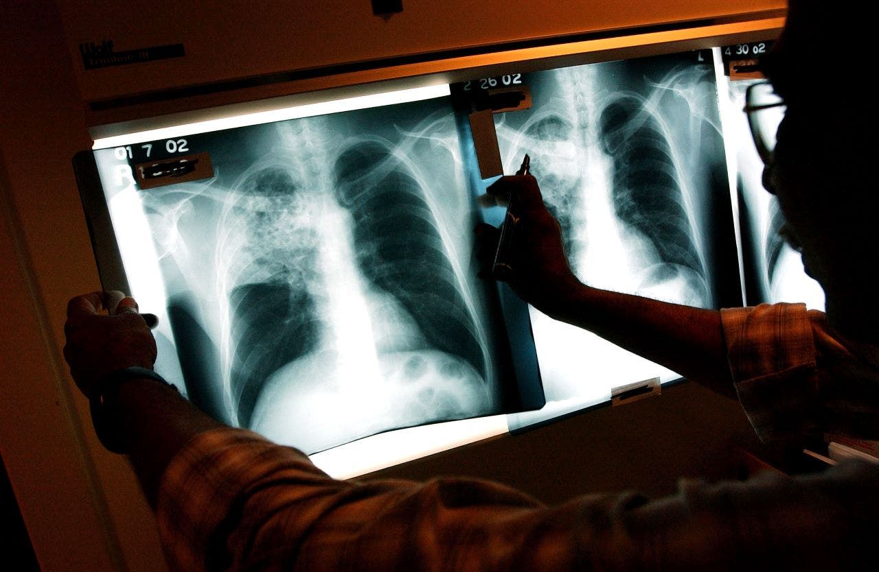 California Tuberculosis outbreak kills 1, infects 14 as officials declare health emergency